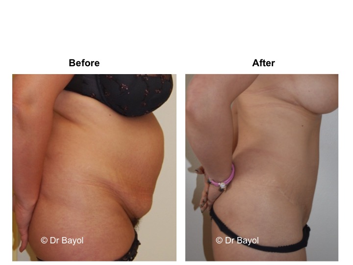 Abdominoplasty Switzerland : tummy tuck Lausanne Geneva - Dr Bayol