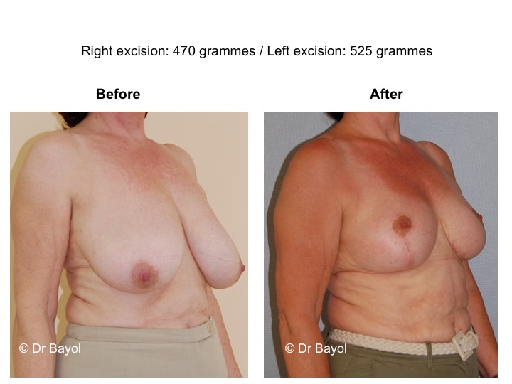 Breast Augmentation (Augmentation Mammoplasty) - Bruner Plastic Surgery