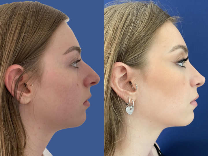 rhinoplastie à Genève