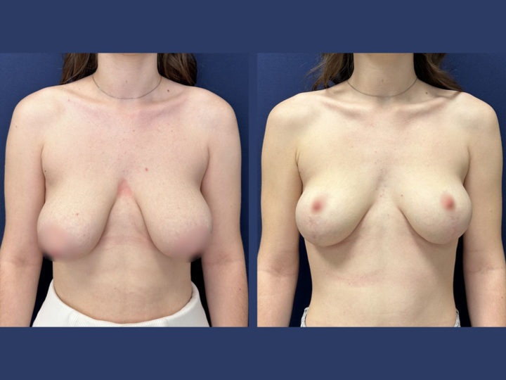 breastlift in geneva